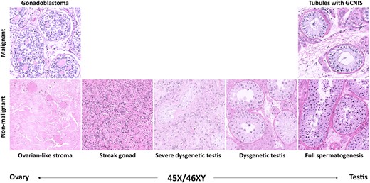The histological spectrum found in the gonadal samples from males with 45,X/46,XY mosaicism. All images show hematoxylin–eosin-stained sections.