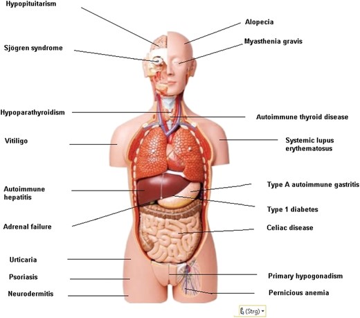 Autoimmune endocrine and nonendocrine disorders in AP.
