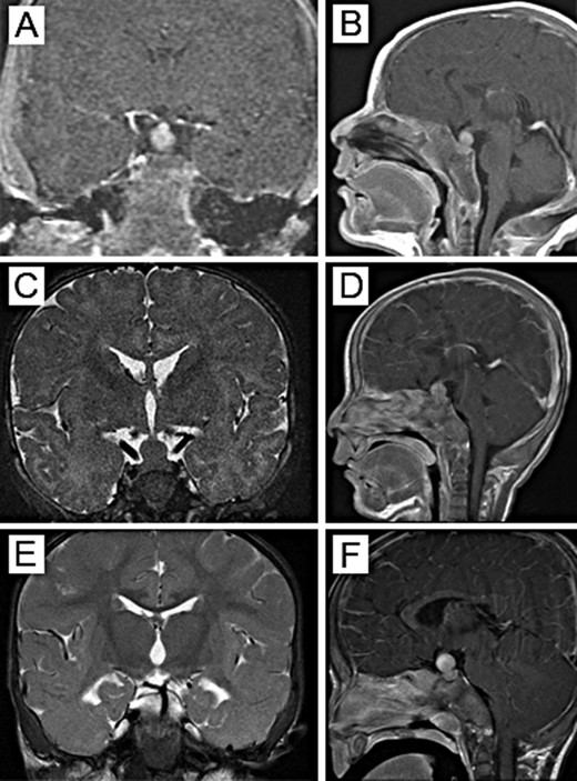 MRI of the pituitary tumor in (A, C, E) coronal and (B, D, F) sagittal views. (A, B) At 3 wk of age, the pituitary mass measured 8.1 × 7.5 × 10.7 mm in the sella with suprasellar extension. (C, D) At 3.5 mo of age, the mass increased to 9.0 × 10.0 × 12.0 mm, without signs of impingement on the optic chiasm. (E, F) By 10 mo of age, the tumor measured 12.5 × 12.5 × 15.1 mm, abutting onto the optic chiasm.