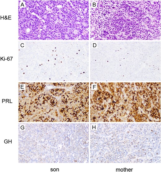 Histological features of (A, C, E, G) infant’s and (B, D, F, H) mother’s pituitary adenomas in the left and right columns, respectively. (A, B) Hematoxylin and eosin–stained sections show neoplastic cells arranged in cords and acinar structures filled with eosinophilic, colloid-like substance. (C, D) The Ki-67 antibody labels many cells in both adenomas, with 8.5% of cells staining positive in the infant and 5.6% in the mother. Many of the neoplastic cells are strongly positive for (E, F) PRL with (G, H) fewer GH positive cells. Magnification, ×20.