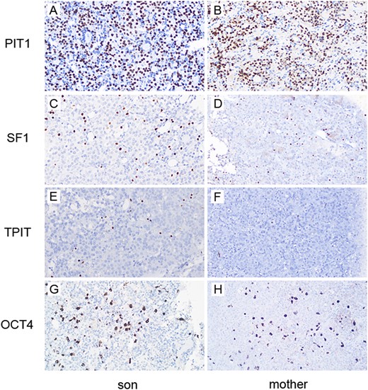 The pituitary adenomas contain multiple cell lineages and express stem cell markers. A majority of the cells are positive for PIT1, a transcription factor expressed in lactotrophs and somatotrophs, in the (A) infant’s adenoma and the (B) mother’s adenoma. Relatively fewer cells are positive for SF1, a transcription factor expressed in (C, D) gonadotrophs, and rare cells express TPIT, a transcription factor expressed in (E, F) corticotrophs. (G, H) An OCT4 immunostain is positive in the cytoplasm and/or nuclei of large subset of cells. Magnification, ×20.