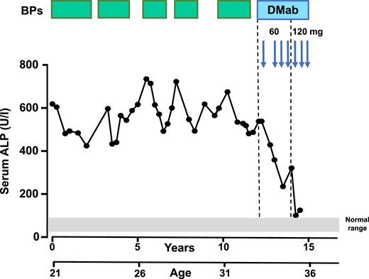 Sequential changes in serum ALP levels in a patient with polyostotic FD (patient 7) during treatment with bisphosphonates (BPs, green boxes) and denosumab (DMab, blue arrows). The gray bar represents the normal laboratory reference range of serum ALP (40 to 98 IU/L). This patient was treated initially with denosumab at a 6-mo interval followed by three 3-mo injections and three 3-mo doses of 120 mg resulting in normalization of bone turnover and reduction in pain complaints. Note the improved response with subcutaneous injections of 60 mg of denosumab and the normalization of serum ALP levels with subsequent injections of 120 mg of denosumab.