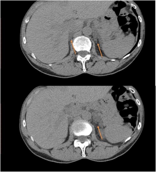 CT images from case 1 showing an enlarged right gland and nodular hyperplasia on the left gland (arrows).