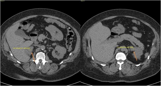 CT images from case 2 showing diffuse bilateral enlargements (arrows).