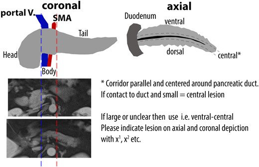Schema of the pancreas which was used for standardized reading by blinded board-certified nuclear medicine physicians and board-certified radiologists.