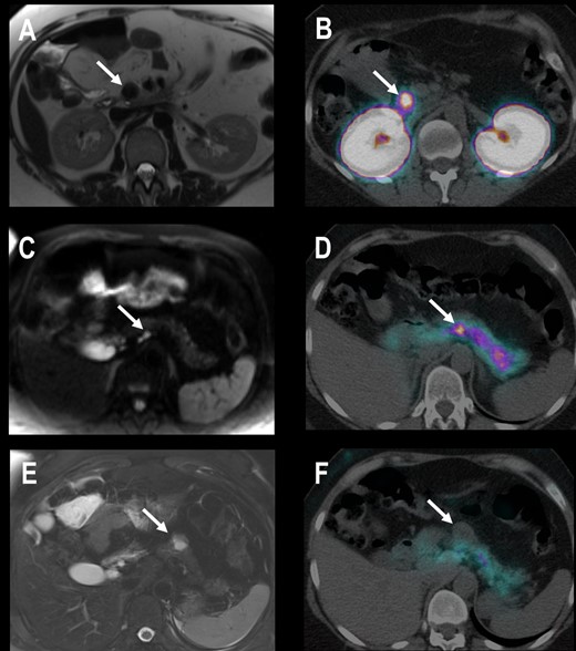 Patient 4 with EHH and three suspicious lesions in MRI. (A) Transaxial contrast-enhanced T1-weighted MRI shows a 20-mm hypointense lesion in the uncinate process of the pancreatic head. (B) Transaxial PET/CT 2.5 h after injection of 68Ga-DOTA-exendin-4 shows an intensive focal uptake in the same lesion. (C) Transaxial diffusion weighted MRI shows a 4-mm hyperintense lesion in the pancreatic body that is 68Ga-DOTA-exendin-4 positive (D). (E) Transaxial T2-weighted MRI shows a 25-mm lesion in the pancreatic tail without 68Ga-DOTA-exendin-4 uptake (F). Histological evaluation revealed one insulinoma in the uncinated process and pancreatic body (both 68Ga-DOTA-exendin-4 PET positive) and an NF-PanNET of 25 mm in the pancreatic tail. All other tumors were no insulinomas and <20 mm and therefore not clinically relevant. EHH resolved after surgery.
