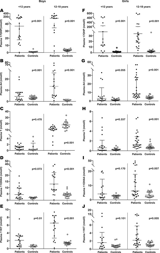 Comparison of plasma steroid concentrations between patients (dark dots) and controls (clear dots). (A–E) Results obtained for boys aged <12 y (left pair of scatter columns) and 12 to 18 y (right pair of scatter columns) for (A) 17OHP, (B) A4, (C) T, (D) 11OHA4, and (E) 11KT. (F–J) Results obtained for girls aged <12 years of age (left pair of scatter columns) and 12 to 18 y (right pair of scatter columns) for (F) 17OHP, (G) A4, (H) T, (I) 11OHA4, and (J) 11KT. The horizontal bars within all scatter columns correspond to the median and interquartile range. Statistical analysis was performed with the Mann Whitney U test.