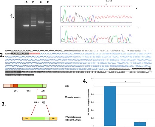 Molecular evidences of LINE-1 insertion. (Upper; 1) Analysis of the LINE-1 insertion site. (Left) Lane A, Agarose gel, normal 46,XY control; lane B, mother of affected individual; lane C, affected individual; and lane D, DNA molecular weight marker. (Right) Sanger sequencing of the 5′UTR AR gene (5′-3′). The insertion starts as a poly(T) at c.-268 position (*index case; **normal male as control); (Middle; 2) Sequencing of the 5′UTR region of AR in the propositus. The 18-bp TSD is marked in gray. The entire inserted LINE-1 sequence is marked in blue. The 11-bp poly(T) is shown in red. This insertion is composed of 804 nt plus poly(A) sequence. This sequence is 99.7% identical to the 3′ end of the putative parental LINE-1HS sequence (AC002980). (3. Schematic representation of the full-length human LINE-1HS. (Upper; 3) The 5′-truncated form of the LINE-1 (nucleotides 5218 to 6021) with 3′-poly(A) tracts. (Middle; 3) Insertion in the 5′UTR region in the AR gene flanked by 18-bp TSD (5′-AAGATCTGGGCATCTTTT-3′) (lower; 3). (4) AR gene expression comparison between affected individual and control.