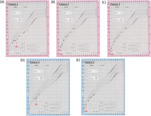 Growth charts of (A) patient 1, (B) patient 2, (C) patient 3, (D) patient 4, and (E) patient 5. The red arrows indicate when GH treatment commenced in the patients.
