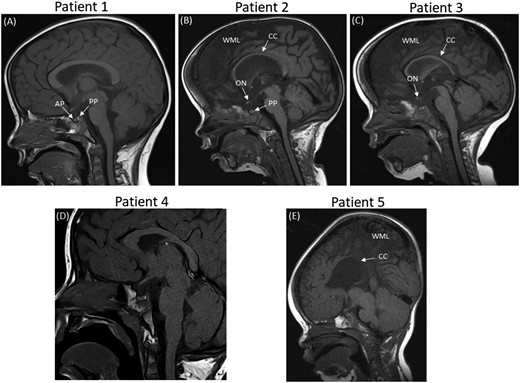 Sagittal MRIs for patients 1–5 showing abnormalities in patients 2, 3, and 5. (A) MRI of patient 1 shows a normal anterior and posterior pituitary, with no other anomalies. (B) MRI of patient 2 (a twin) reveals global cerebral hemisphere atrophy with a small posterior pituitary, a thin corpus callosum, and small optic nerves. (C) MRI of patient 3 (a twin) reveals generalized underdevelopment of the brain. The posterior pituitary is normal with small optic nerves and a thin corpus callosum. (D) MRI of patient 4 shows a normal anterior and posterior pituitary, with no other anomalies. (E) MRI of patient 5 shows generalized underdevelopment of the brain and a very thin corpus callosum. AP, anterior pituitary; CC, corpus callosum; ON, optic nerve; PP, posterior pituitary; WML, white matter loss.