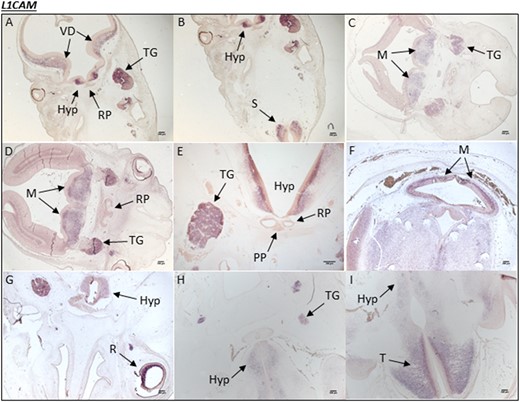 Human L1CAM expression during embryonic development. (A and B) A human embryonic section from CS19 showing L1CAM mRNA transcripts in the developing hypothalamus (Hyp), ventral diencephalon (VD), and trigeminal ganglia (TG). (B) mRNA transcripts can be seen in the spinal cord (S). In a different embryo section at (C) CS19 and at (D) CS20, L1CAM expression is noted throughout the metencephalon (M) and again in the TG. There is no mRNA transcript staining in the RP at either stage. (E) In a different embryo section at CS20, specific expression is seen throughout the hypothalamus and in the TG. (F) At CS23, L1CAM expression is observed ubiquitously throughout the brain, particularly in the M; (G) it is also present in the retina (R) of the eye. (H) A different embryo section at CS23 shows that L1CAM expression is partially maintained in the Hyp and TG. (I) At CS23, there is strong expression in the telencephalon (T) (forebrain).
