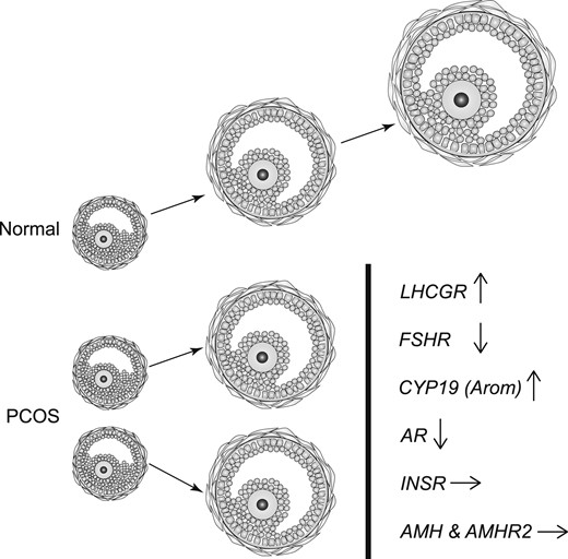 Summary of the key findings that we postulate are causally related to the mechanism of follicle arrest in PCOS. Expression of LHCGR is increased in a significant subpopulation of granulosa cells (GCs) in small antral follicles from PCOS. Increased LH activity may account for downregulation of both FSHR and AR, but increased aromatase (CYP19) expression is consistent with the notion that steroidogenesis is exaggerated, or at least conserved, in arrested follicles (8). Hyperinsulinemia may contribute to follicle arrest, but expression of insulin receptor (INSR) is unchanged. Expression of both AMH and AMHR is similar in normal and PCO follicles, and the role of AMH in arrested follicle growth in PCOS remains uncertain.