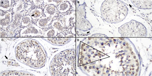 Immunoexpression patterns of DHX37 in testis tissues. (A) Newborn testis showing strongly positive staining in occasional spermatogonia (arrow) among numerous Sertoli cells, some of which show weak cytoplasmic staining (original magnification ×100). (B) Seminiferous tubules of a 13-year-old boy, demonstrating tubules with predominance of Sertoli cells, all of them negative for DHX37. Note some positive stromal cells (arrow; original magnification ×100). (C) Adult testis of a 54-year-old man, showing positive Leydig (arrow) and germ-cell staining. (original magnification ×100) (D) Detail of C, showing the different pattern of stain in different stages of germ cells. Note strong perinuclear halo in spermatogonia, progressive paranuclear condensation in spermatocytes and spermatids, and absence of DHX37 expression in spermatozoa (original magnification, ×20).