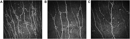 Representative images of corneal nerve fibers in (A) a glucose-tolerant control individual with normal corneal nerve branch density (CNBD) and (B) a patient with painful diabetic polyneuropathy showing reduced CNBD compared with the control, but markedly higher CNBD in comparison with (C) a patient with painless diabetic polyneuropathy. White dotted circles indicate main corneal nerve branches.