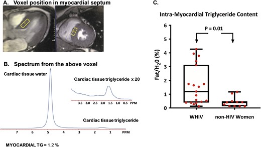 Cardiac MRS and intramyocardial triglyceride content in women with and without HIV. (A) Intramyocardial triglyceride content was measured for each participant by placing voxels (rectangle) over the intraventricular septum, as shown in representative (right) sagittal and (left) axial cardiac cine images. The intraventricular septum was chosen as the site of measurement because it contains myocardial tissue without overlying epicardial adipose tissue, which would affect the assessment of intramyocardial triglyceride content. (B) An example of a cardiac proton spectrum is shown. The spectrum includes a myocardial water signal (the larger peak) and myocardial triglyceride signal (the smaller peak). The intramyocardial triglyceride for this example spectrum shown is 1.2% and was calculated as a percent of the myocardial water signal. (C) Intramyocardial triglyceride content is displayed as median (interquartile range) for each subgroup, with whiskers representing minimum and maximum values, respectively. Intramyocardial triglyceride content was significantly higher among WHIV compared with non-HIV-infected women (P = 0.01). PPM, parts per million; TG, triglyceride