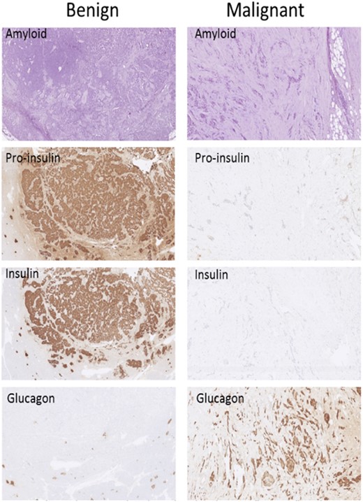 Immunohistochemistry findings in a localized tumor (left column, “Benign”) and in a tumor that had metastasized (right column, “Malignant”). Amyloid staining is included to better visualize the structure of the tumor because routine hematoxylin and eosin staining was not available. (Original magnification, ×70.)