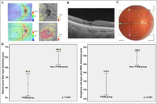 SS-OCT examination and observed difference between thickness of inner retinal layers in kidney transplant recipients with and without PTDM of >5 years. (A) SS-OCT thickness maps of RNFL and GCL++ according to Early Treatment Diabetic Retinopathy Study. (B) Retinal layers by high-resolution SS-OCT shows inner retina thinning. (C) Color fundus photograph shows no clinical sign of diabetic retinopathy. (D) Thinning of RNFL and GCL++ in patients with PTDM, respectively.