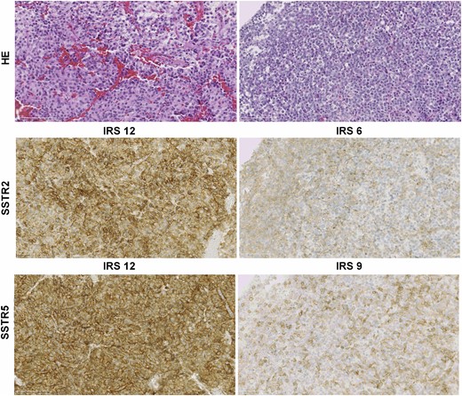 SSTR2 and SSTR5 protein expression of somatotroph adenomas scored by the IRS. HE, hematoxylin and eosin.