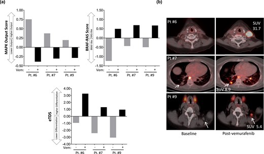 MAPK signaling, thyroid differentiation, and 124I avidity. Two serial biopsies were performed on the same tumor for each patient, allowing correlation of drug-induced molecular changes with 124I dynamics measured by PET/CT. (a) RNA was extracted from the two serial biopsies for RNAseq to quantify transcripts regulated by MAPK output, the BRS, and the eTDS. The MAPK output score, BRS, and eTDS values represent the average fold change for all mRNAs in the gene set compared with the median of all the samples. (b) Fused 124I PET/CT images of the serially sampled tumors analyzed in (a). Gray bars indicate scores calculated in tumors obtained before vemurafenib. Black bars indicate scores calculated from biopsies obtained from the same tumors after 10 to 11 d on vemurafenib. Vem, vemurafenib.