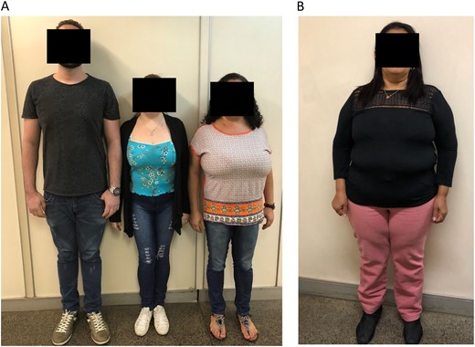 Pictures of patients who presented with CPP due to DLK1 defects. (A) Two affected sisters (patients 1A and 1B) who presented with truncal obesity and macromastia from family 1 are shown in the left panel. (B) An affected female patient (patient 3B) with short stature and obesity from family 3 is shown in the right panel.