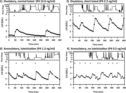 Sleep stages (wake, REM, N1, N2, and N3, in descending order) and pulsatile LH secretion in representative subjects from the four progesterone exposure groups, demonstrating the relationship between P4 level and LH pulse frequency during sleep. Studies were performed on day 5 or 6 of cycle 2. P4 = maximum serum progesterone detected in cycle 1. Inverted triangles indicate LH pulse nadirs.