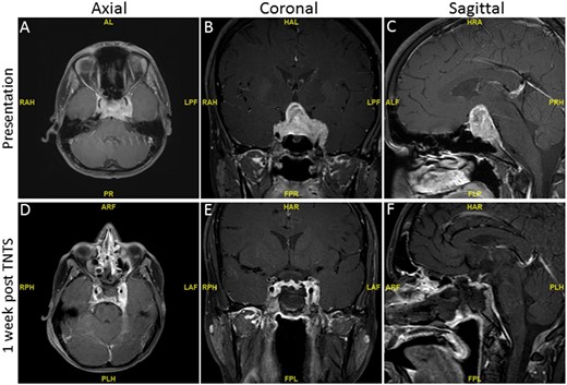 T1-weighted preoperative and postoperative MRI of a large sellar and suprasellar mass with bilateral cavernous extension before and 1 wk after endoscopic transsphenoidal surgery (TNTS). (A, D) Axial view. (B, E) Coronal view. (C, F) Sagittal view.