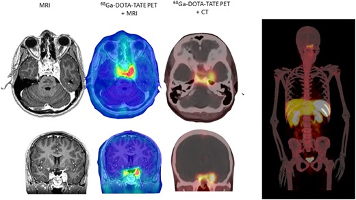 Axial and coronal brain MRI and 68Ga-DOTA-TATE (whole body) image in immediate postoperative period (1 mo postoperatively).