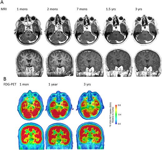 Serial (A) axial and coronal MRI and (B) 18F-FDG-PET/CT images at various postoperative intervals.
