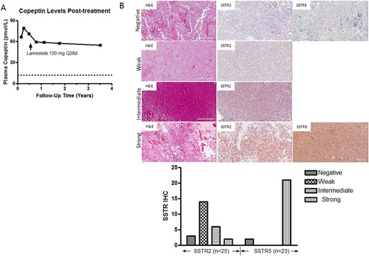 (A) Plasma copeptin levels at 1 mo postoperatively and at intervals during SRL therapy. (B) Representative hematoxylin and eosin (H&E) SSTR2 and SSTR5 immunostaining results (original magnification ×20) in a series of NCs. Immunostaining scores were quantitated using the histoscore (range, 0 to 300), representing the product of staining intensity (absent, 0 to 100; weak, 100 to 200; intermediate, 200 to 300; strong, >300) and percentage of tumor cell staining (range, 0 to 100).