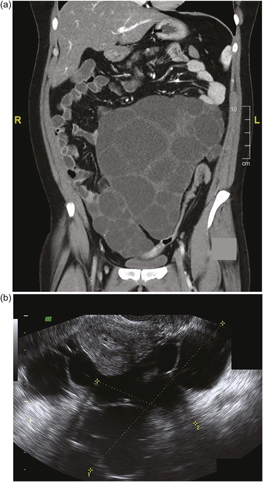 (a) Coronal CT scan shows bilaterally enlarged polyfollicular right and left ovaries measuring 15 cm and 17 cm, respectively. (Largest right ovarian diameter is not shown.) (b) Sagittal transvaginal ultrasonography shows a right ovary measuring 11.3 × 9.5 cm next to the uterus. (Left ovary measuring 18.6 × 14.1 cm is not shown.) L, left; R, right.