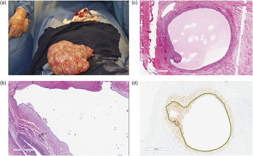 Operative findings of massively enlarged ovaries. (a) Left ovary and fallopian tube at surgery. The left ovary weighed 3219 g (volume 23.0 × 17.0 × 8.5 cm3) and contained multiple benign follicular cysts with clear serous fluid. The right ovary was similar in appearance but was smaller. (b) Hematoxylin and eosin stain of a serous cystadenofibroma (PI by Ki-67 stain, 1.02 ± 0.80%) adjacent to a follicular cyst (PI, 2.42 ± 1.90%). (c) Hematoxylin and eosin stain of a Graafian follicle. (d) PI of granulosa cells within the same Graafian follicle (PI, 99%).