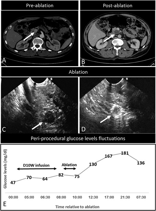 Disease characteristics in an insulinoma patient successfully treated with EUS-RFA (index patient number 2). (A) Three-phase CT examination (axial view), showing a contrast-enhanced lesion (12 mm in diameter) in the uncinate process of the pancreas (arrow), later diagnosed as an insulinoma. (B) Three-phase CT examination (axial view), 6 months after RFA. Complete ablation is reflected by the presence of a nonenhancing area at the ablation site (arrow). (C) EUS examination confirming the hypoechoic tumor lesion (arrow). (D) EUS image of the lesion obtained during the RFA. The peripheral hyperechoic area at the ablation site reproduced the shape of the treated tumor (arrow). (E) Time frame of glucose-level fluctuations in the patient before, during, and post-EUS-RFA procedure. Ablation, EUS-RFA procedure; D10W infusion, continuous 10% dextrose infusion.