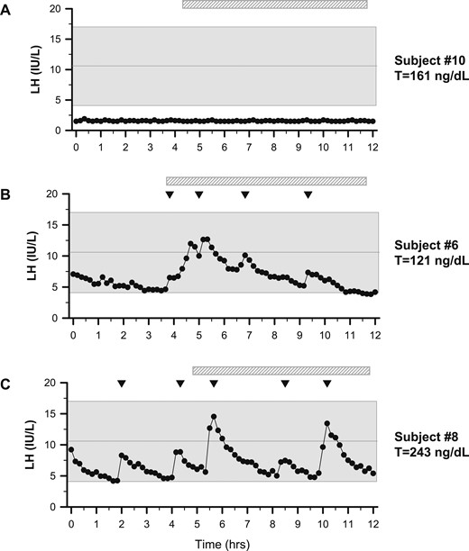 Representative graphs of LH secretion patterns in three men with FHH. Subjects underwent neuroendocrine profiling (every 10 minutes × 12 hours) to chart GnRH-induced LH secretion. (A) Subject 10 was the lone patient with an apulsatile LH secretion pattern. (B) Subject 6 displayed sleep-entrained pulses (hatched bar depicts sleep period). (C) Subject 8 exhibited a normal LH secretion pattern with characteristic peaks, as observed in healthy controls (42). Shaded region represents the normal reference range (27). Inverted triangles indicate LH pulses.