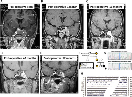 Coronal T1-weighted MRI of the sella showing a large pituitary adenoma with left cavernous sinus invasion (A) at diagnosis; (B) 1 month after surgery; (C) 16 months after surgery; (D) 42 months after surgery, just before gamma knife therapy; and (E) 52 months after surgery, 9 months after gamma knife therapy. (F) The family pedigree chart shows incomplete penetrance. The arrow marks the proband. (G) Sanger sequencing shows a heterozygous AIP c.241C>T mutation in blood leukocytes and loss of heterozygosity in the tumor. (H) Genomic positions with loss of heterozygosity in the tumor sample were identified using VarScan and are marked in blue.