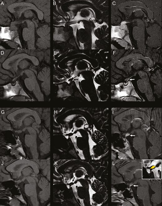 Presence and absence of the “mismatch pattern” in idiopathic central diabetes insipidus. Left column: sagittal 3-mm-thick pre-contrast T1-weighted images; Middle column: sagittal 0.6-mm-thick T2-DRIVE sequence; Right column: sagittal 3-mm-thick postcontrast T1-weighted images. A-F: 6-year-old girl. Baseline MRI (A-C) shows enlargement of the pituitary gland with absent bright spot and thickened pituitary stalk with homogeneous contrast-enhancement. Follow-up MRI at 1 month (D-F) demonstrates marked spontaneous reduction in size of the gland and thinning of the stalk with linear contrast-enhancement matching the thickness of the stalk on T2-DRIVE. There is concomitant marked reduction in size of the pituitary gland. G-L: 10-year-old girl. Baseline MRI (G-I) shows pathologic thickening of the median eminence with amputation of the infundibular recess (black arrow, H) and concomitant thickening of the proximal pituitary stalk with homogeneous contrast-enhancement. There is lack of visibility of the bright spot. Incidentally noted is a cystic pineal gland. Follow-up MRI (J-L) at 1 year shows stable thickening of the median eminence and proximal pituitary stalk on T2-DRIVE (black arrow, K) with a pattern of mismatch on postcontrast imaging. postcontrast T1-weighted image reveals only a linear contrast-enhancement along the posterior margin of the proximal pituitary stalk without enhancement of the median eminence thickening. Stable dimensions of the pituitary gland. There is reduction in size of the pineal gland cyst.