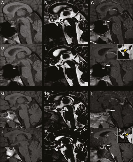 “Mismatch pattern” in idiopathic central diabetes insipidus and Langerhans cell histiocytosis. Left column: sagittal 3-mm-thick precontrast T1-weighted images; Middle column: sagittal 0.6-mm-thick T2-DRIVE sequence; Right column: sagittal 3-mm-thick postcontrast T1-weighted images. A-F: 13-year-old boy with idiopathic central diabetes insipidus. Baseline MRI (A-C) shows absent bright spot and pathologic thickening at the midportion of the stalk with homogeneous contrast-enhancement. The infundibular recess is clearly visible. Follow-up MRI at 4 years demonstrates thinning of the stalk midportion with thickening of the median eminence and lack of visibility of the infundibular recess (black arrow, E). postcontrast T1-weighted image shows a mismatch pattern at this level. There concomitant reduction in size of the gland. G-L: 9-year-old girl with Langerhans cell histiocytosis. Baseline MRI (G-I) shows pathologic thickening of the median eminence and of the proximal pituitary stalk with homogeneous contrast-enhancement. There is lack of visibility of the bright spot. Follow-up MRI (J-L) performed at 1 year since the end of chemotherapy shows evident reduction of the median eminence and proximal pituitary thickening, with lack of visibility of the infundibular recess on T2-DRIVE (white arrowhead, K). Postcontrast T1-weighted image shows a mismatch pattern at this level. There is reduction in size of pituitary gland with persistent lack of visibility of the bright spot.