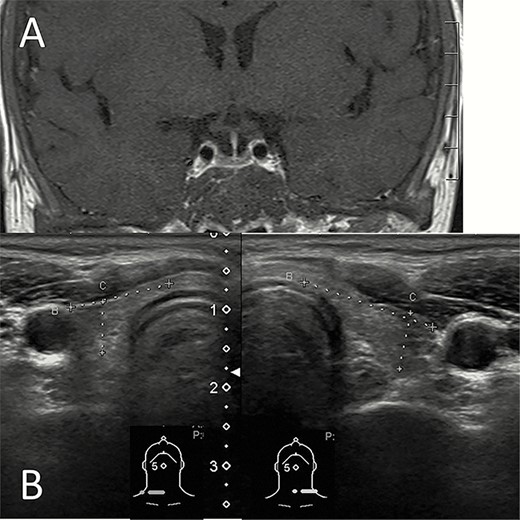 Hemochromatosis of the pituitary and thyroid glands. (A) T1 weighted image with contrast of the magnetic resonance imaging shows that the pituitary gland was relatively small and decreased contrast enhancement resulted in low signal intensity. (B) Thyroid sonography shows a small thyroid gland with low echogenicity.