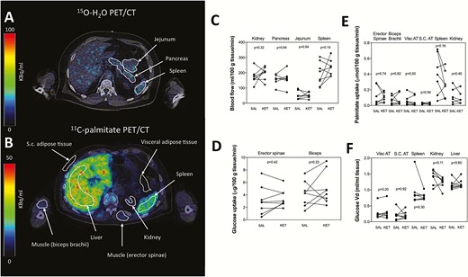Substrate uptake and perfusion. Volumes of interest (VOIs) in the kidney, pancreas, jejunum, and spleen for detection of perfusion measured with 15O-H2O PET/CT (A). VOIs in the humeral flexor muscle, erector spinae muscle, subcutaneous fat, visceral fat, spleen, kidney, and liver for estimation of palmitate and FDG uptake (B). Perfusion, 18F-FDG uptake and palmitate uptake was unchanged during ketone body infusion in all tissues (C, D, E, F). Liver data not shown in figure E due to a several fold higher palmitate uptake compared with other tissues. 18F-FDG, 18F-fluorodeoxyglucose; KET, ketone; min, minutes; PET/CT, positron emission tomography/computed tomography; SAL, saline; S.C., subcutaneous; Vd, volume of distribution; visc, visceral.