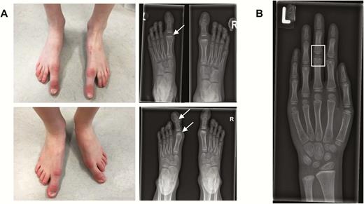 Photographs and radiographs of the feet and hand of the proband´s daughters. (A) Macrodactyly of the great toes of the eldest (upper panels) and youngest daughter (lower panels). The radiograph of the eldest daughter shows iatrogenic bone abnormalities on the distal part of metatarsal 1 after ablation of the pseudo-epiphyses (upper panel; white arrow). The pseudo-epiphyses in the first metatarsophalangeal joint and proximal interphalangeal joint of the youngest daughter are clearly distinguishable (lower panel; white arrows). (B) Left hand of the eldest daughter. The mid- and proximal phalanges of all fingers show pseudo-epiphyses (white square). Carpalia and metacarpals are normal.
