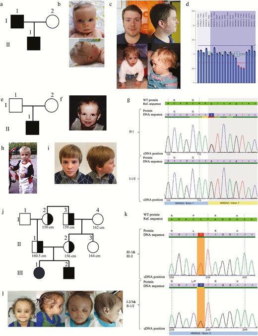 Phenotypes and genetic testing results in the 3 families. Pedigree of (A) family 1, (B) father of patient 1 as child (age 1 year) and adult (32 years), (C) patient 1 (age 9 months), and (D) multiplex ligation-dependent probe amplification. Pedigree of the (F) family, (E) patient 2 (age 3.8 years), (G) electropherogram, (H) patient 2 (age 4 years), and (I) patient 2 (age 8 years). Pedigree of (J) family 3, (K) electropherogram of patient 3 and heterozygous affected relatives (I-2, I-3, II-1, II-2), and (L) patient 3 and her brother.