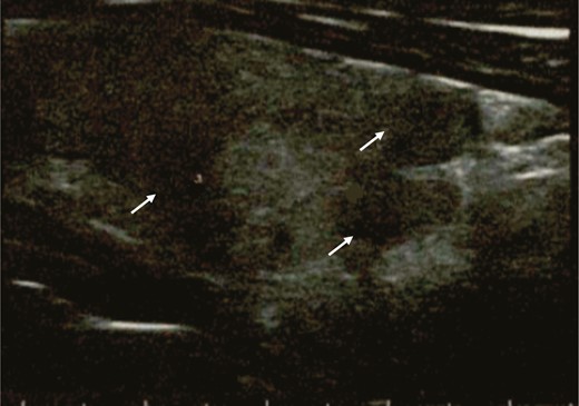 Thyroid ultrasound performed during the thyrotoxic phase, showing multiple hypoechoic areas (arrows).