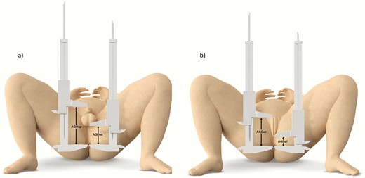 Illustration of AGD measurements in boys (a) and girls (b), using the Cambridge method. Abbreviations: AGDAP, anogenital distance (ano-penile); AGDAS, anogenital distance (ano-scrotal); AGDAC, anogenital distance (ano-clitoral); AGDAF, anogenital distance (ano-fourchettal).