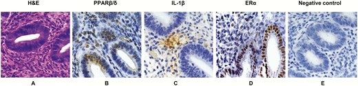 Immunohistochemistry of peroxisome-proliferator-activated receptor β/δ (PPARβ/δ), interleukin1β (IL-1β), and estrogen receptor α (ERα) in endometrium. A, A hematoxylin-eosin (H&E)-stained section of proliferative endometrium is provided to illustrate relevant tissue morphology. B, Immunoperoxidase histochemistry (brown precipitate) shows nuclear localization of PPARβ/δ in endometrial glands and stroma. C, Immunoperoxidase histochemistry (brown precipitate) shows focal, lacy stromal cytoplasmic localization of IL-1β in an adjacent section. D, As a positive control, anti-ERα antibodies stained epithelial and stromal nuclei. E, A negative control, in which the primary antibodies were substituted with nonimmune serum. All sections were counterstained with Mayer’s hematoxylin. Similar findings were observed in n = 3 tissue sections. Magnification × 200.