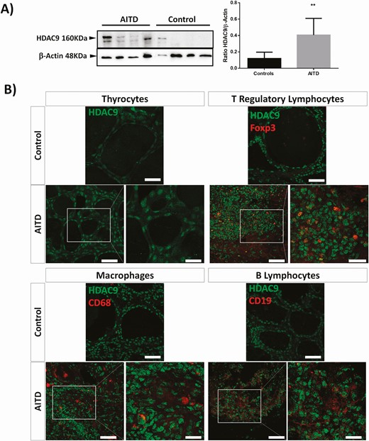 Analysis of HDAC9 levels in thyroid gland samples from AITD. A) Western blot analysis of tissue sample homogenates from healthy and AITD thyroid glands. A significant overexpression of HDAC9 was detected in AITD thyroid gland samples. **P < 0.01. B) Double immunofluorescence microscopy analysis of HDAC9 expression (green fluorescence), Foxp3, CD68, and CD19 (red fluorescence) in thyroid gland tissue sections from controls and patients with AITD. An increased immunostaining of HDAC9 is observed in samples from AITD. Cell nuclei were stained with DAPI (blue fluorescence). Scale bar = 50 µm and 25 µm (details in white square).