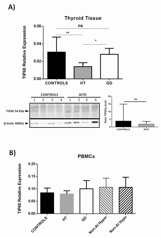 Analysis of Tip60 expression in thyroid glands and PBMCs from patients with AITD and controls. A) Significant diminished levels of Tip60 were detected in gland samples from patients with HT compared with both GD and controls (upper panel). Homogenates of thyroid gland samples analyzed by Western blot from patients with HT and GD showed a tendency of decreased levels of Tip60 HAT (54 kDa band, lower panel) compared with controls. Data correspond to the arithmetic mean and SD. Abbreviation: ns, not significant; *P < 0.05; **P < 0.01. B) Analysis of Tip60 mRNA levels in PBMCs from patients with AITD (HT and GD) as well as from patients with nonautoimmune hyper- and hypothyroidism. Cells from healthy controls were also analyzed. No significant differences among all the groups studied were observed.