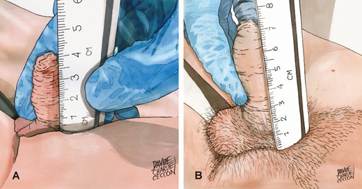 The new measurement method consists of gently placing the flaccid penis next to a rigid centimeter ruler held perpendicular to the body axis and strongly compressed on the pubic bone, without exerting any traction. The measurement is carried out up to the glans tip, excluding the foreskin perceived with the examiner’s fingers.