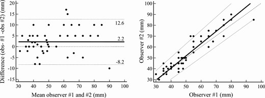 Interobserver analysis of resting penile measurement. A, Bland-Altman plot: mean (solid line), ±95% limits of agreement (dotted lines), and equality (dashed line) are shown. B, Passing and Bablok regression: mean (solid line), ±95% CI (dotted lines), and equality (dashed line) are shown. Individual measurements are shown as dots.