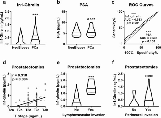 Comparison between urine In1-ghrelin levels and plasma PSA levels. Urine In1-ghrelin levels (A) and plasma PSA levels (B) were determined in patients diagnosed with PCa (n = 213) and patients with negative biopsy result (NegBiopsy; n = 397). (C) AUC of plasma PSA and urine In1-ghrelin to distinguish between PCa and NegBiopsy patients. Association of urine In1-ghrelin levels with tumor stage (T stage; D), lymphovascular invasion (E) and perineural invasion (F) in patients with PCa with PSA in the grey zone who underwent radical prostatectomy (n = 79). ***P < 0.001 indicate values that significantly differ between groups. Coefficients of correlation (R) were evaluated by Pearson’s test.