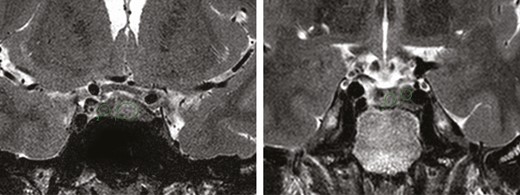 Examples of the T2-weighted MRI intensity measurements. Depicted region of interest (ROI) in the adenoma (1) and adjacent normal pituitary gland (2). (A) Hyperintense tumor with a T2 intensity ratio of 1.57. (B) Hypointense tumor with a T2 intensity ratio of 0.53.