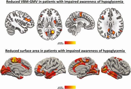 Patients with T1D and IAH compared with patients with T1D and NAH, controlling for age, sex, and education (P < 0.05 corrected). VBM-GMV reductions (above) and surface area reductions (below). Reductions are indicated by a red-to-yellow color scale. Abbreviations: GMV, gray matter volume; IAH, impaired awareness of hypoglycemia; NAH, normal awareness of hypoglycemia; T1D, type 1 diabetes; VBM, voxel-based morphometry.